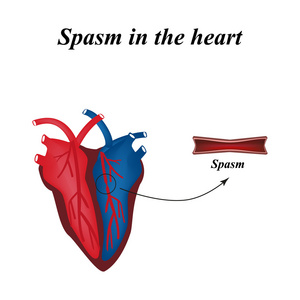 心脏动脉痉挛。信息图表。矢量图