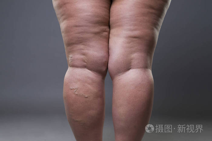 腿上的肥胖纹_祛肥胖纹_大如何祛肥胖纹腿