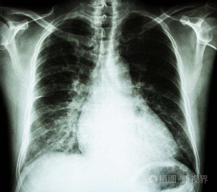 心脏衰竭(x线片胸部平正:显示心脏病