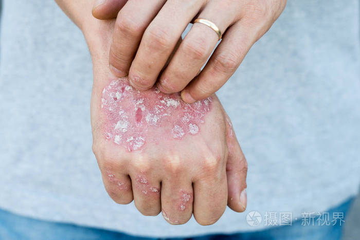 男人手上抓自己片状皮肤干燥与寻常型银屑病湿疹和其他皮肤状况如真菌