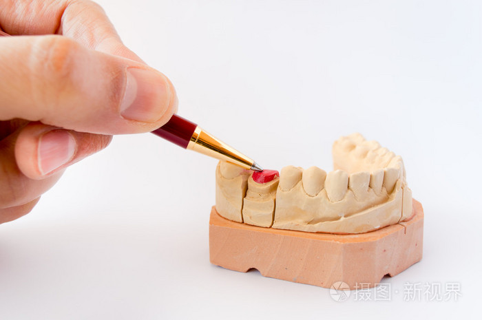 牙科石膏模型