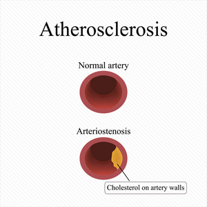 动脉粥样硬化。血液中的高胆固醇。矢量图