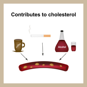 咖啡 香烟和酒精提高血液中的胆固醇水平。胆固醇斑块。信息图表。矢量图