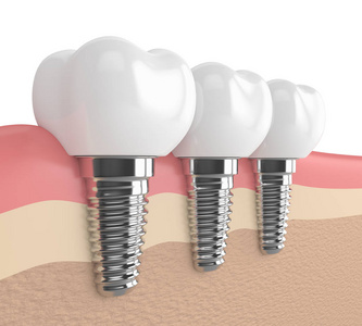 3d 牙科植入物在牙龈中的呈现