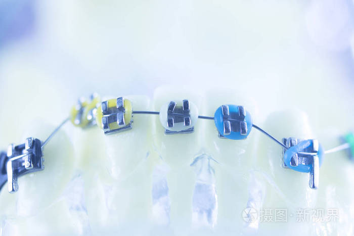 正畸牙医教学模式牙科牙齿塑料和金属支架器, 以理顺每颗牙齿