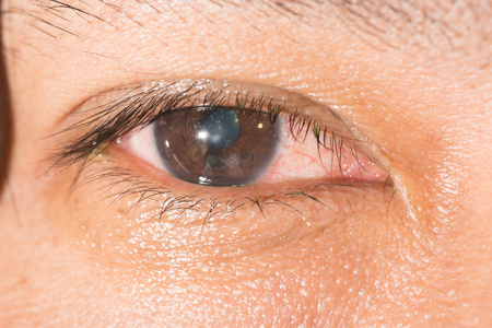 角膜锈环在眼试验
