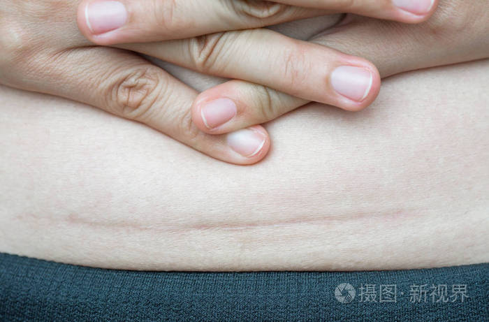 特写的女人显示在她的腹部黑色疤痕剖宫产