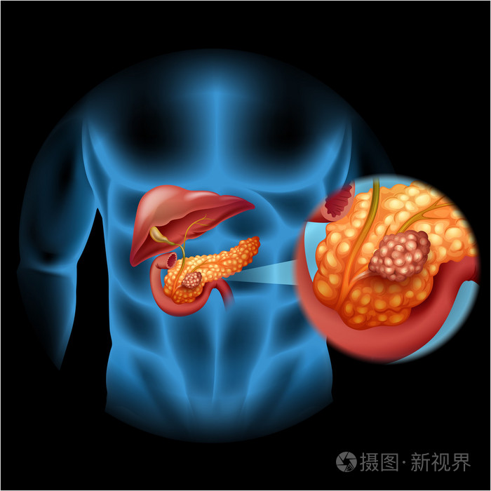 在人体的胰腺癌症图
