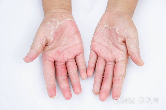 干手剥离接触性皮炎真菌感染皮肤感染从曝光