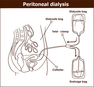 腹膜透析均用于肾载体 illus 的治疗