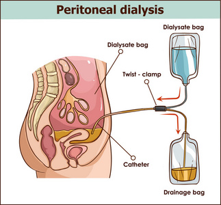 腹膜透析均用于肾载体 illus 的治疗