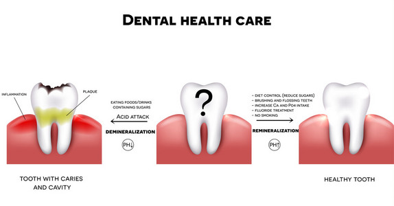 牙科保健 健康牙与牙龋