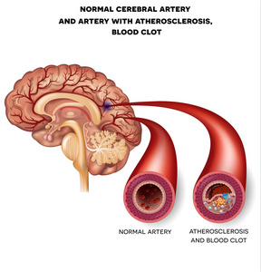 正常的脑动脉和动脉的血凝块