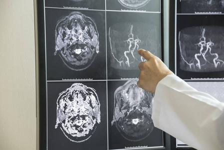 磁共振成像对脑解剖学的诊断