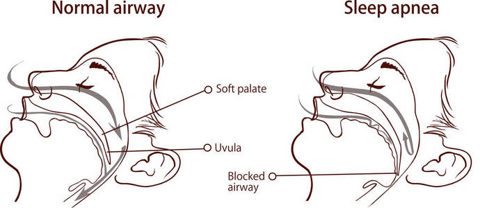 睡眠呼吸暂停综合征的矢量说明图片