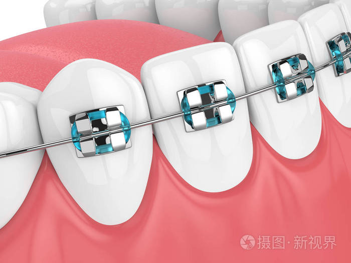 3d用牙齿和正畸牙套进行颚部渲染
