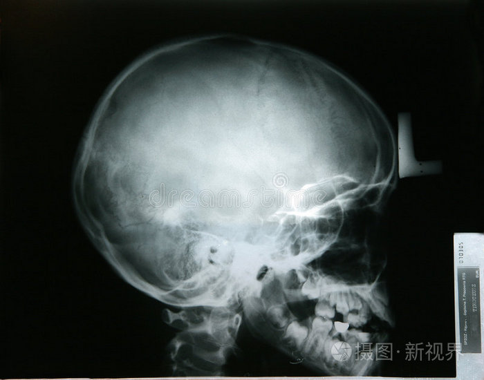 我弟弟头部的x光片