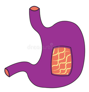 紫外线胃图片