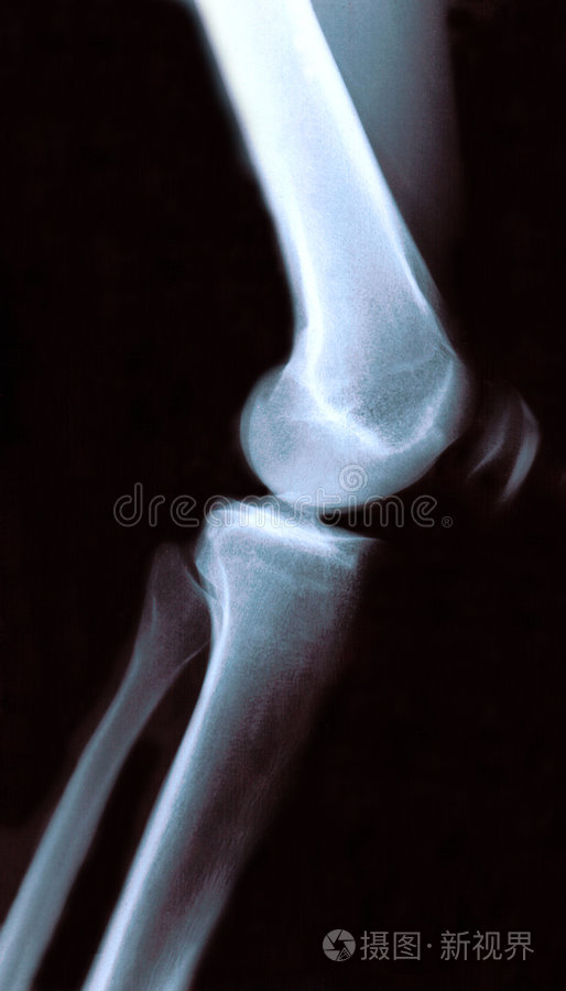(大腿骨)膝关节腓骨骨折腓骨完全性骨折(腿骨)正常人的膝盖膝关节x光