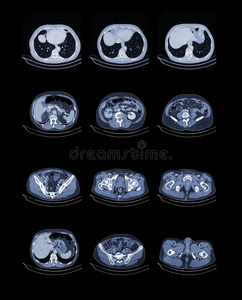 胸腹部计算机断层扫描