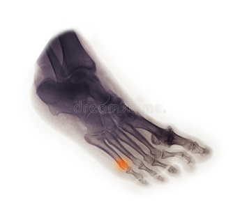 足部x光片显示第5跖骨骨折