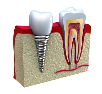 健康牙与牙种植体的解剖学研究