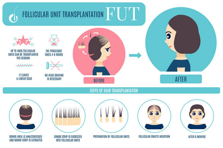 Fut 头发移植为妇女
