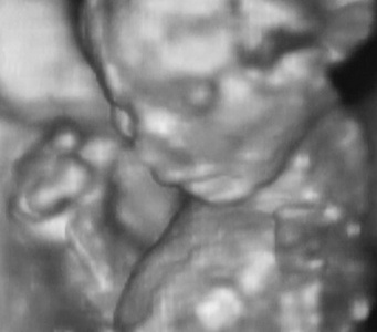 第 4 个月胎儿，意大利实验室的 3d 超声检查分析。