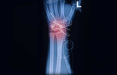 X 射线图像的腕关节，显示 k 线桡骨骨折