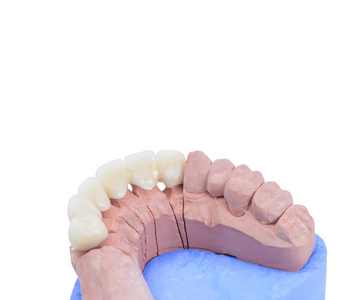 在白色背景下关闭义齿陶瓷模型