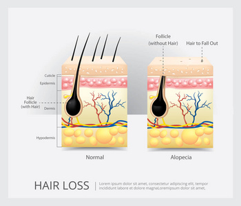 脱发结构矢量图解