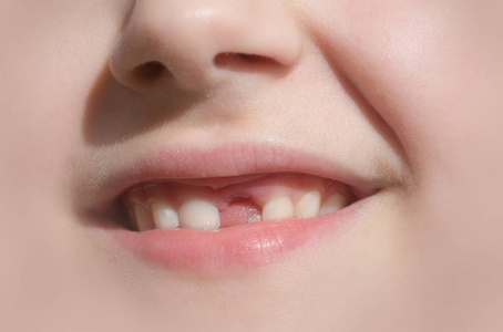 孩子的微笑没有前牙。儿童牙科和健康