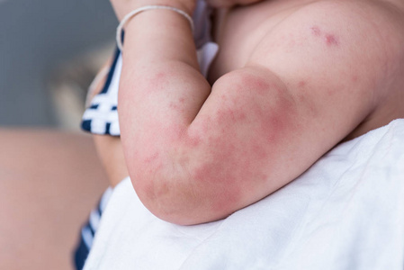 婴儿的皮肤纹理遭受严重荨麻疹，荨麻疹