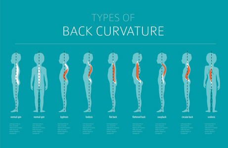 背曲率的类型。医疗疾病图表