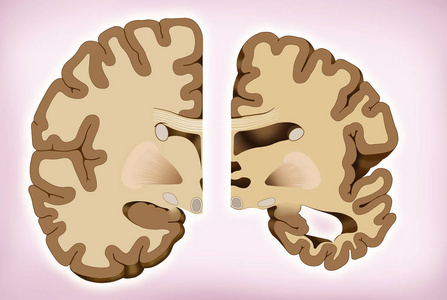 这个插图显示了大脑两个半部分的比较, 一个健康的一半, 另一个是阿尔茨海默氏症的