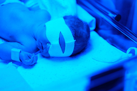 刚出生的婴儿，在蓝色的紫外光照射下