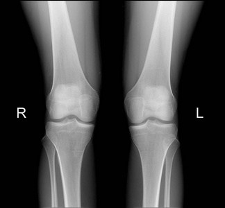 X 射线的正面投影正常膝关节