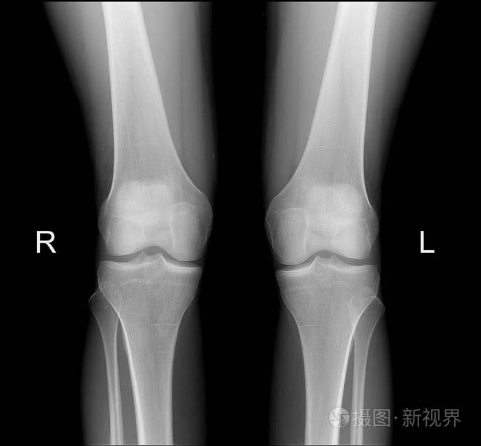 x 射线的正面投影正常膝关节