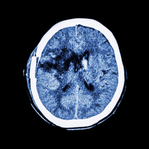 脑CT扫描右基底节区陈旧性出血