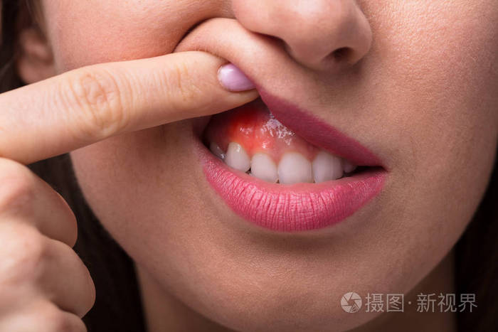 一个女人的手指特写显示她的牙龈肿胀照片-正版商用图片0pyio3-摄图新