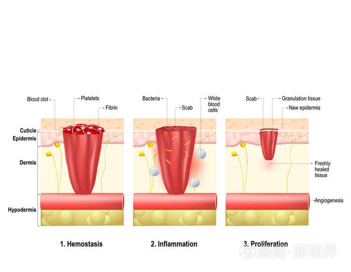 伤口愈合.过程中身体组织修复创伤后