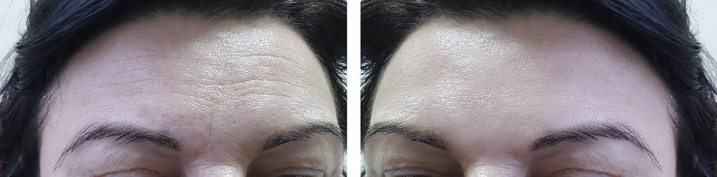 面部妇女额头皱纹前和后化妆程序
