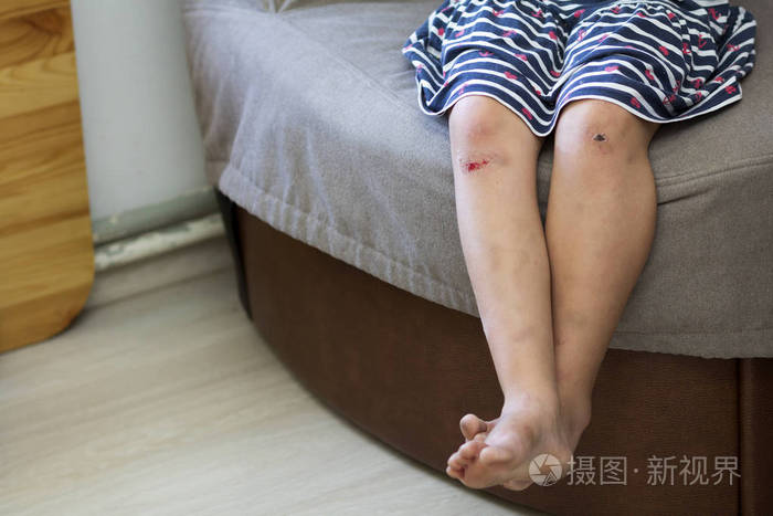 近距离的幼儿女孩赤脚腿与伤痕累累受伤的膝盖后下降与旧的疤痕和新鲜