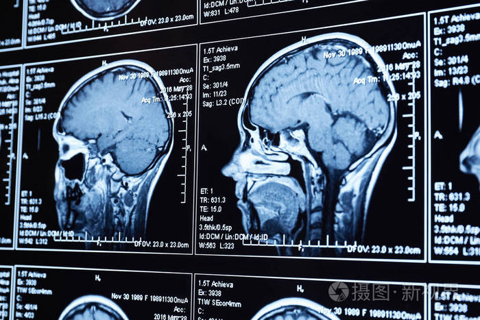大脑的磁共振扫描磁共振头颅扫描