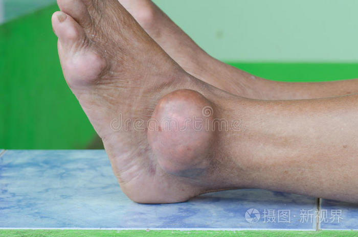 痛风病人的脚