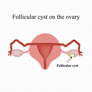 卵泡的卵巢囊肿。功能性囊肿。信息图表。矢量图