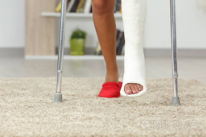前视图关闭一个残疾妇女的腿与石膏脚在家里散步