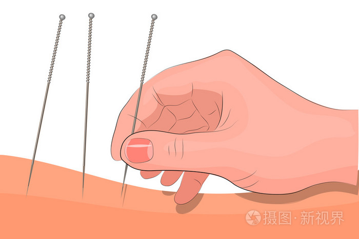 手与针灸针插画-正版商用图片0qvb8z-摄图新视界