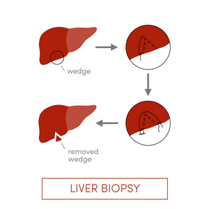 肝脏活检, 简单的向量例证