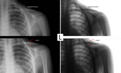 X 射线的左锁骨。儿童锁骨骨折。骨折合并。标记。积极。负面